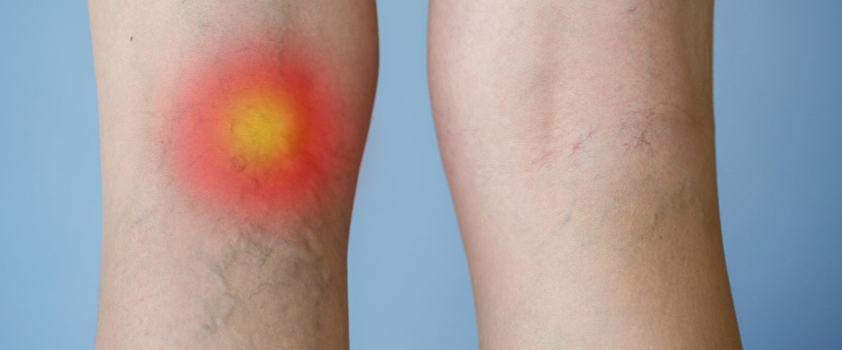 Standing All Day = Chronic Foot Pain? Can Compression Socks Prevent Varicose Veins?
